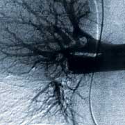 angiographie scintigraphie